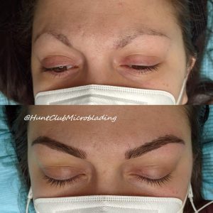 Instant Face Lift of Combination Brows